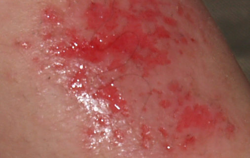 methylisothiazolinone scrutiny