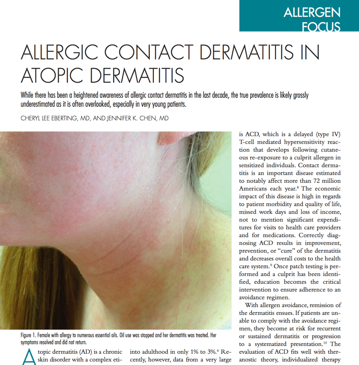 Allergic Contact Dermatitis In Atopic Dermatitis Dermatitis Academy